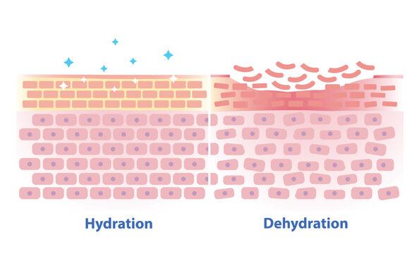 Comparison of hydration and dehydration skin vector illustration. Cross section of skin barrier layer hydration, attract, absorb water, moisture and the skin lacks water in the uppermost layer.