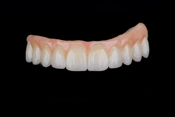 Two stages of making full dental zirkonium prosthesis on titanium bar. Raw before sintering and layered or painted zirkonium.