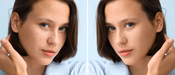 Beautiful young woman with acne problem on blue background