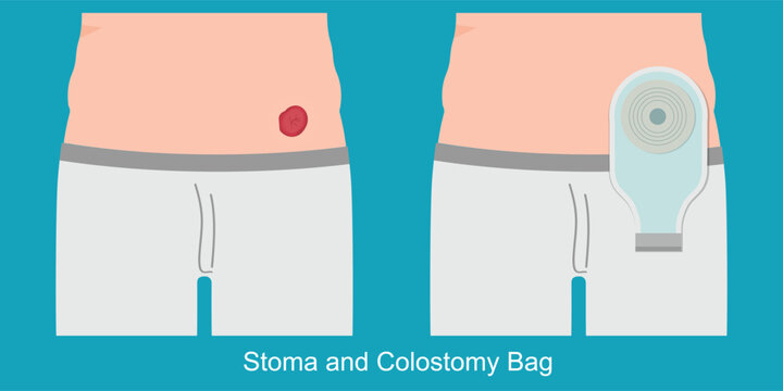 A colostomy is a surgical procedure that changes the trajectory of food waste.