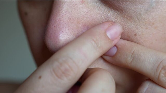 Close-up of a woman's nose with blackheads on a light grey background. A girl showing black dots on her nose. Acne problem, comedones. Enlarged pores on the face. Cosmetology dermatology concept