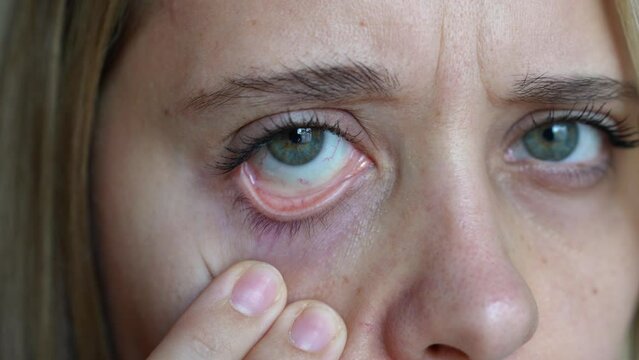 Cropped shot of a young caucasian woman showing off her red inflamed conjunctiva and dilated capillaries. Hemorrhage under the conjunctiva. Disease of retina of the eye. Conjunctivitis, keratitis