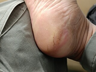 close up of the cracked heel of the man's foot