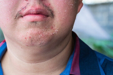 Close up of face Skin peels from sunburn, causing itching and burning.