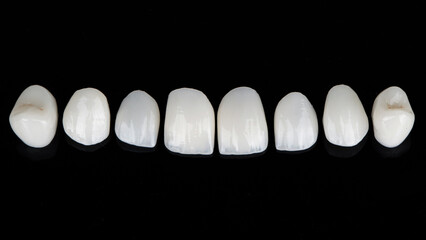 set of ceramic veneers for total prosthetics of the upper jaw, top view on a black background © Dental Pro Content