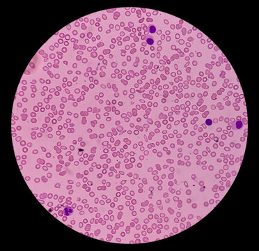 PBF (peripheral blood film): Blood smear thalassemia showing hypochromia,schistocyte,NRC,Target cells. Severe thrombocytopenia.