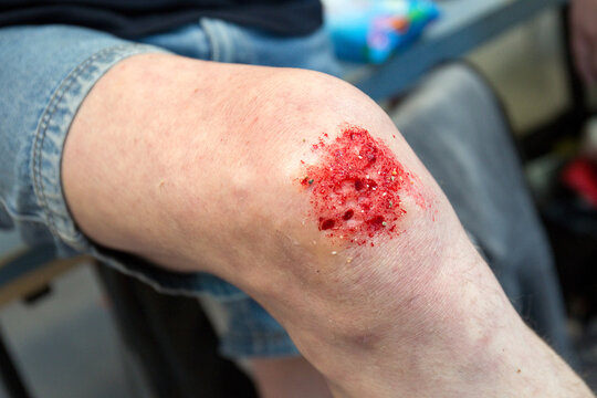EHBO training met lotusslachtoffers van mensen met een diepe wond met bloed.