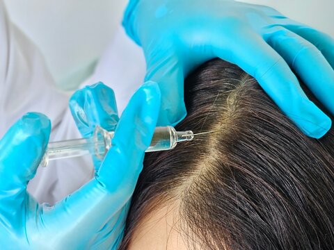 Close-Up of Hair Loss Treatment Injection Administered by Medical Professional