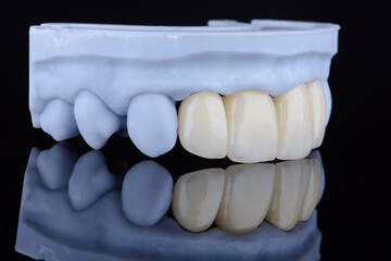 High-quality naturally dental single crowns made of zirconium for fixation to the frontal teeth of upper jaw. © gorynvd