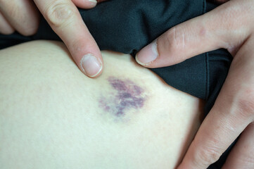 Cropped shot view of woman having wound and bruises on her thigh after Injured from falling or...