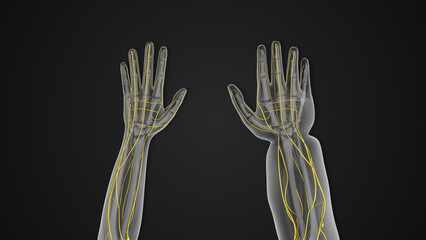 Lymphedema disorder characterized by swelling of the hand