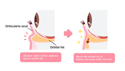 How to remove dark circles under the eyes with Lower blepharoplasty (Transconjunctival blepharoplasty)