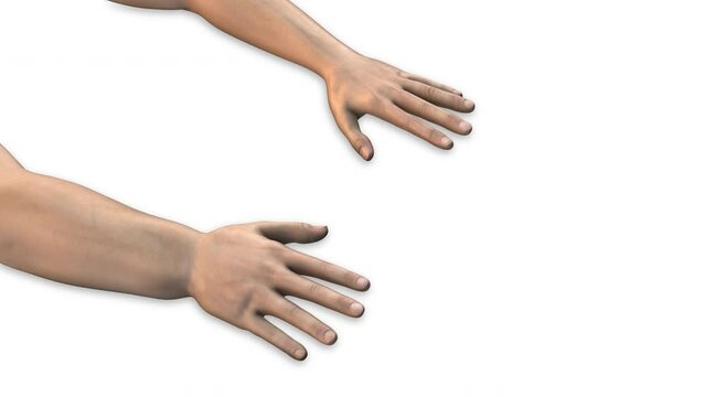 Edema swollen hand or arm lymphedema disease