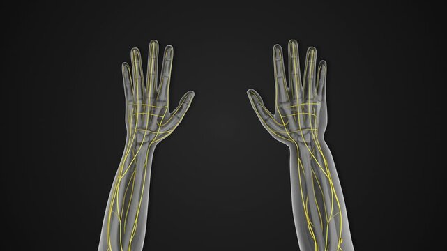 Lymphedema disorder characterized by swelling of the hand