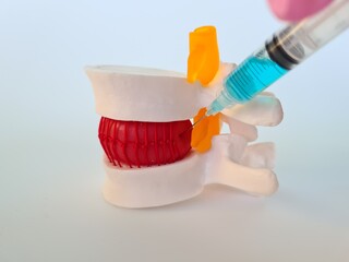Syringe Injecting Blue Liquid Into Red Disc Model of Spine