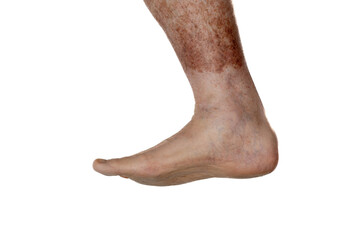 Foot Pain Concept on White Background - Podiatry and Orthopedic Health