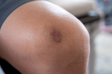 Bruised Knee after playing sports