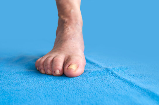 Pie y tobillo de mujer mayor con v&aacute;rices sobre alfombra azul. Lesiones y enfermedades del pie. 