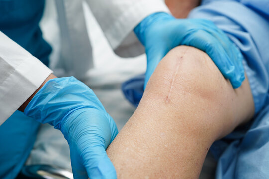 Asian elderly woman patient with scar knee replacement surgery in hospital.
