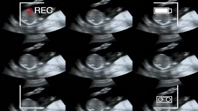 A collage of images of a fetus ultrasound screen for medical reference and study
