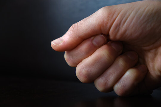Bleeding hangnail of a female hand on dark background close-up. Ill injury. Ripped off skin. Concept of bad habits, biting and ripping off hangnails on fingernails. High quality photo