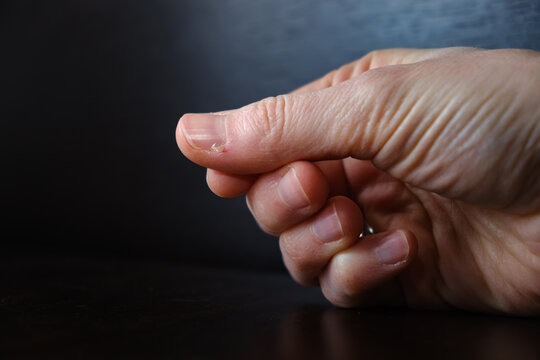 Bleeding hangnail of a female hand on dark background close-up. Ill injury. Ripped off skin. Concept of bad habits, biting and ripping off hangnails on fingernails. High quality photo