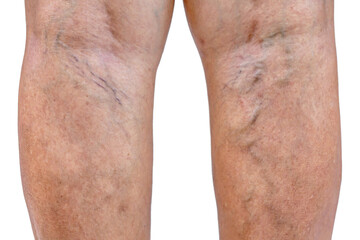 Naklejka premium Painful varicose and spider veins on womans legs ,active life concept.