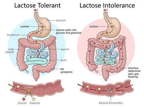 lactose tolerance and intolerance in the digestive system, illustrating symptoms and processes in intestines diagram hand drawn schematic raster illustration. Medical science educational illustration