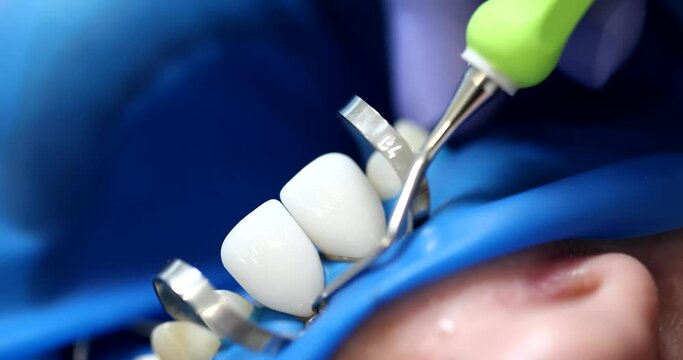 Dentist removes white ceramic veneers from teeth of patient using pointed dental equipment. Professional care of human cavity in clinic slow motion