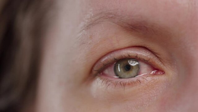 Red blood eye of woman affected by conjunctivitis or after flu, cold or allergy