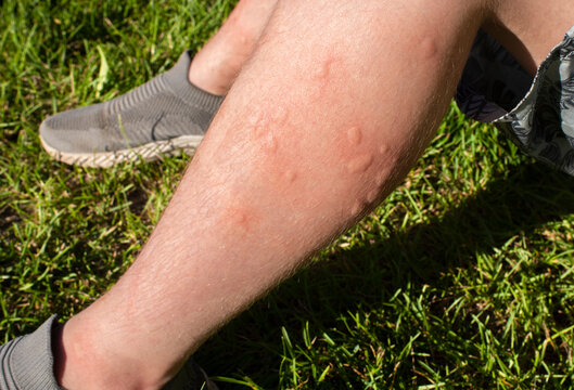 traces of multiple mosquito bites on the child&rsquo;s legs