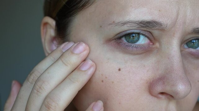 A sick young caucasian woman showing dark circles under her eyes with hand on a dark grey background. Pale skin, bruises under the eyes are caused by disease, fatigue, lack of sleep, insomnia, stress