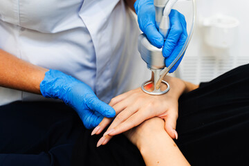 Applying CO2 resurfacing laser on hand of woman in cosmetology clinic. Laser removing scars from...