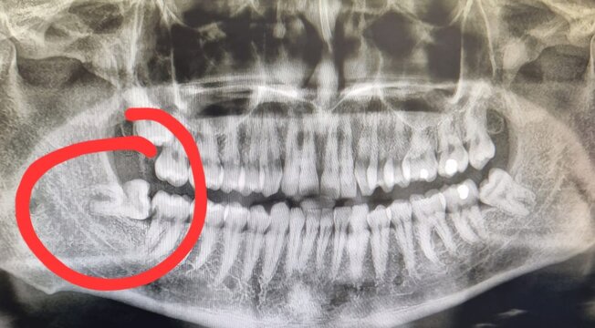 Impacted wisdom teeth