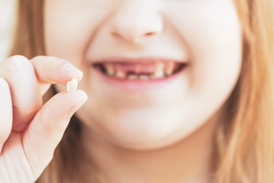 Close-up of smile of girl without upper front teeth, holding lost baby tooth in her hand. Growing up children, pediatric dentistry, changing baby teeth to permanent concept.