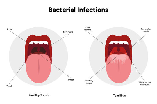 Viral bacterial infection, sore throat, tonsillitis, and healthy tonsils medical diagram 
