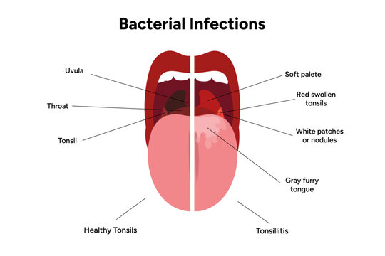 Viral bacterial infection, sore throat, tonsillitis, and healthy tonsils medical diagram 