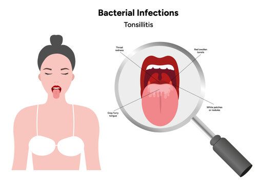 Woman with open mouth, viral bacterial infection, sore throat, tonsillitis, medical diagram zoom