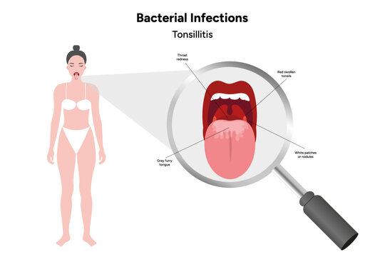 Woman with open mouth, viral bacterial infection, sore throat, tonsillitis, medical diagram 
