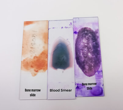 Bone marrow slide, megaloblastic anemia, mylodysplastic anemia, MDS disease, one stained glass slide, one pbf slide ang one unstained slide.