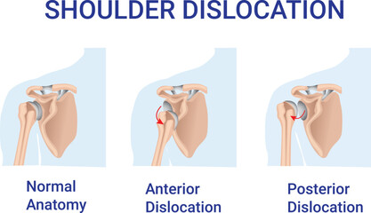 Shoulder Dislocation, normal anatomy, anterior Dislocation and  posterior dislocation illsutration