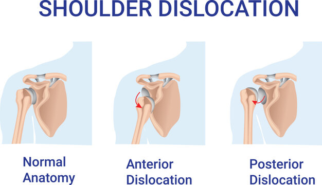 Shoulder Dislocation, normal anatomy, anterior Dislocation and  posterior dislocation illsutration