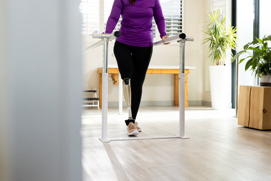 Woman in prosthetic leg walking using parallel bars for rehabilitation therapy