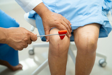 Doctor neurologist testing reflex knee with hammer and show Asian senior scars surgical total knee joint replacement.