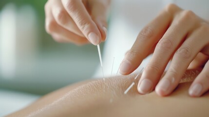 Close-up of hands performing acupuncture on a person's back, demonstrating traditional Chinese medicine and therapeutic techniques.