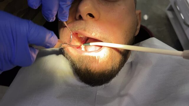 Close-up of a dental procedure showing a dentist extracting a wisdom tooth from a patient's mouth, highlighting the precision and care involved in oral surgery