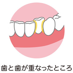 歯と歯が重なったところに溜まった歯垢　歯磨き　磨き残し