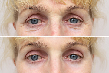 Close-up of an elderly woman's eyes before and after blepharoplasty. Rejuvenation procedure, correction of the upper and lower eyelids. Removing wrinkles and puffiness under the eyes. Mesotherapy