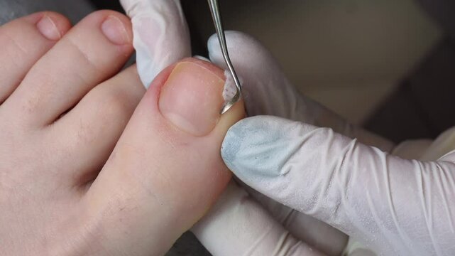 Medical pedicure, podiatrist doing tamponade to a deformed toenail
