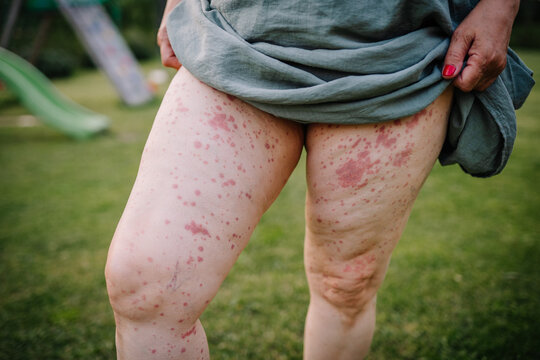 Close-up of a woman's legs showing a skin rash caused by Human Parvovirus (Parvovirus B19), standing in a grassy area.